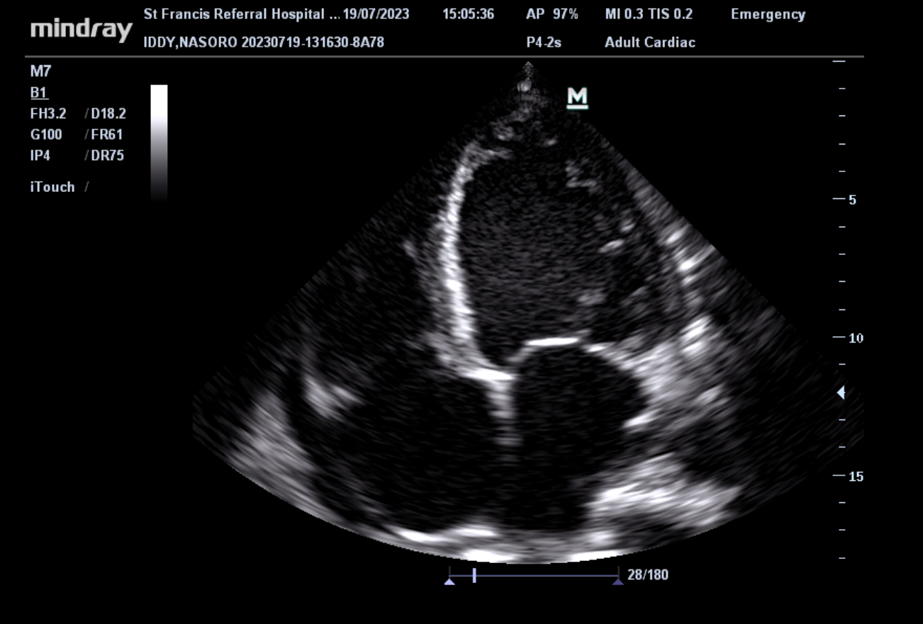 Improving Heart Failure Treatment in Rural Tanzania - "Sacubitril-Valsartan Interventional Study"