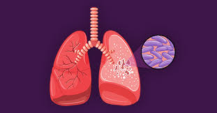 Biological Determinants and Epidemiological Consequences of Subclinical Tuberculosis