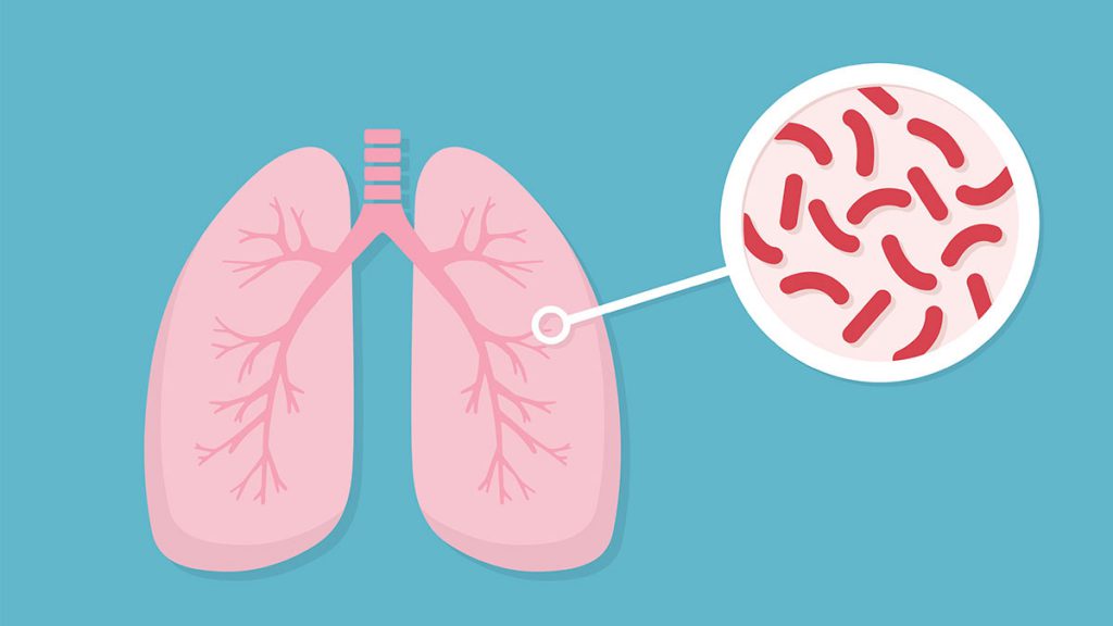 A clinical trial evaluating an improved treatment regimen for drug-sensitive tuberculosis - " OptiRiMox TB Project"